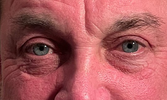 male patient after receiving blepharoplasty