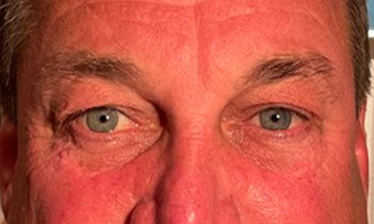 middle aged male patient before blepharoplasty