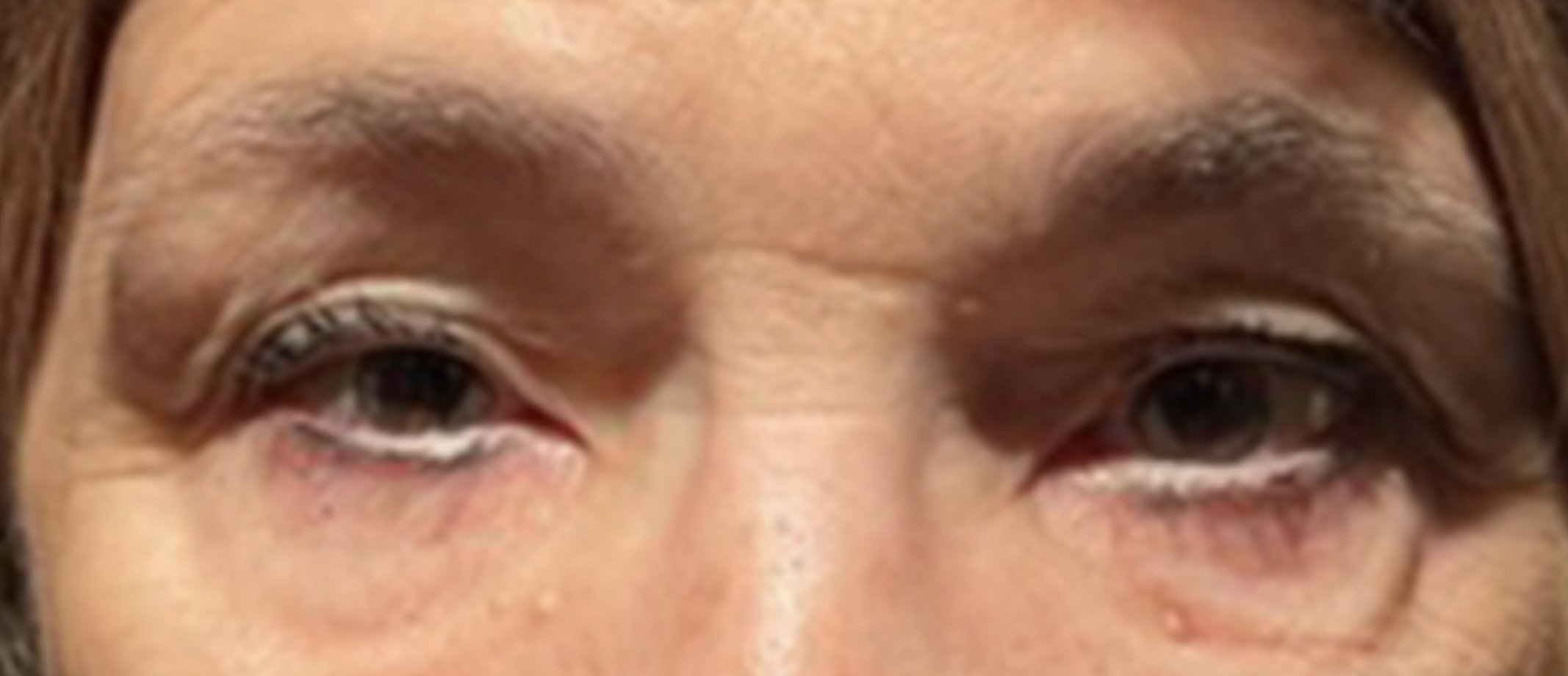 close up eyes for lower blepharoplasty before the procedure