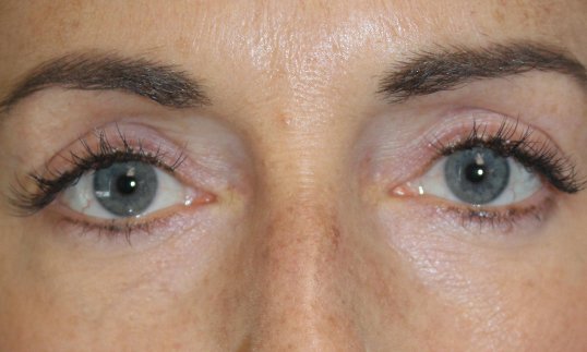 female with blue eyes after blepharoplasty surgery