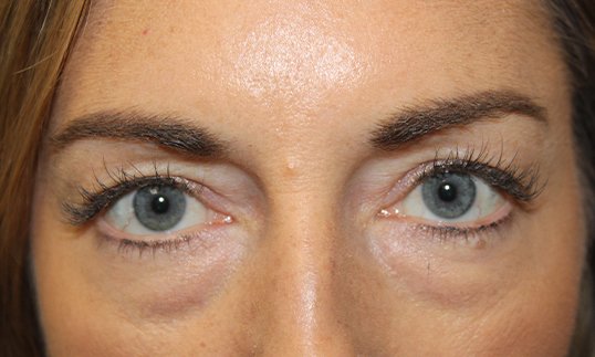 lower blepharoplasty before on female patient with blue eyes