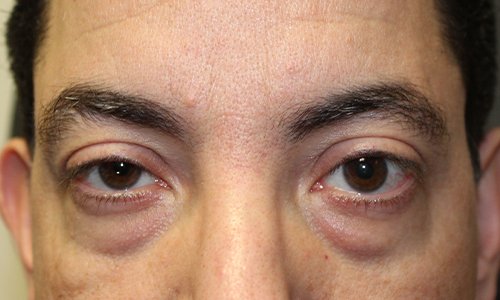 male patient before lower blepharoplasty proceudre