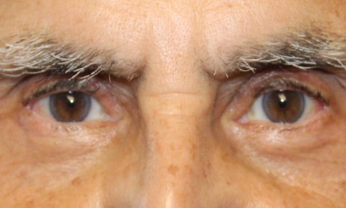 male patient lower blepharoplasty procedure after results
