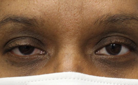 woman before ptosis eye repair