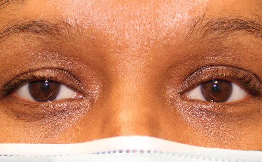 results of ptosis repair on female patient with brown eyes