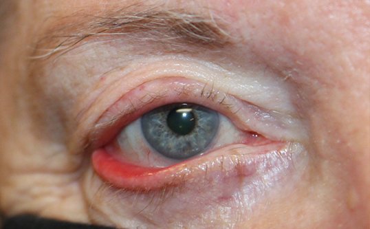 mans eye before entropion eyelid repair surgery
