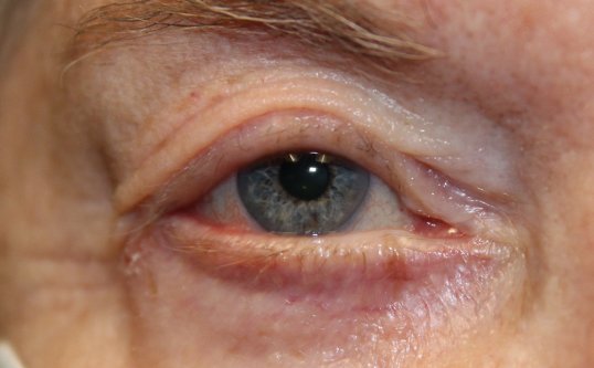 mans eye after entropion repair surgical procedure