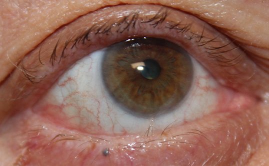 close up of eye after trichiasis repair