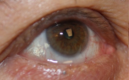 close up of eye after trichiasis repair