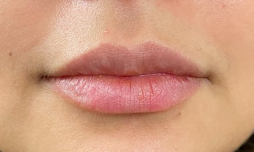 womans lips after filler treatment