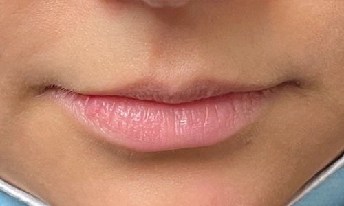 lips after fillers