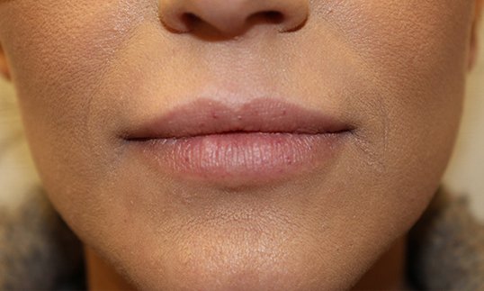 womans full lips after luvederm