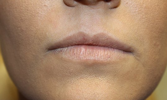 womans lips before juvederm