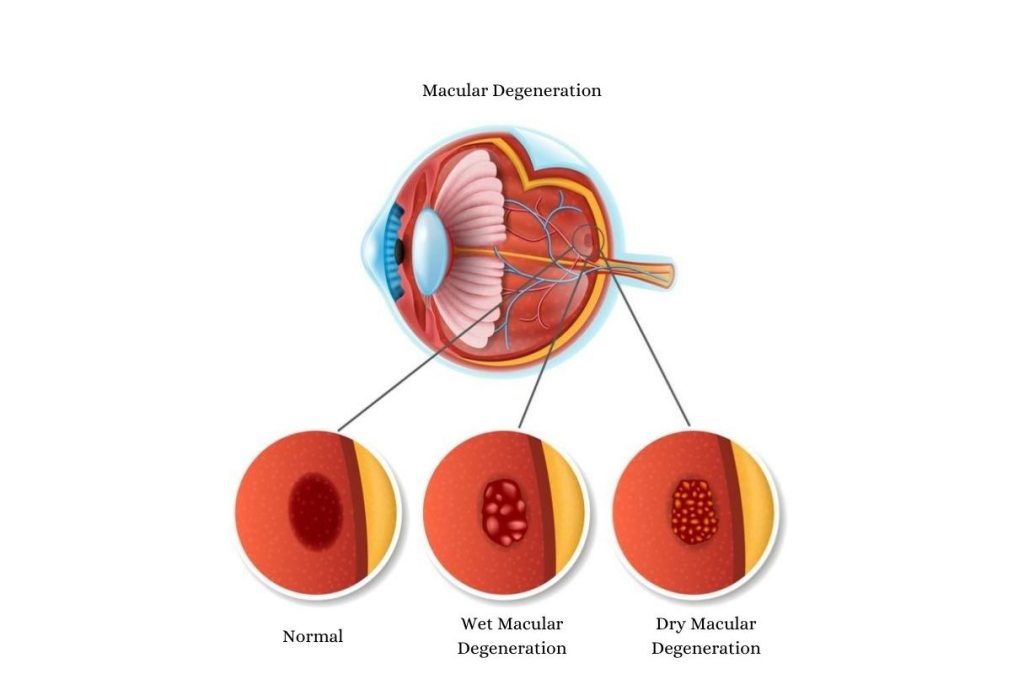 diagram of different macular degeneration types