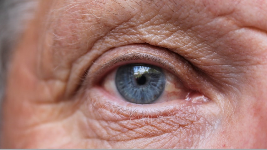 eye with macular degeneration