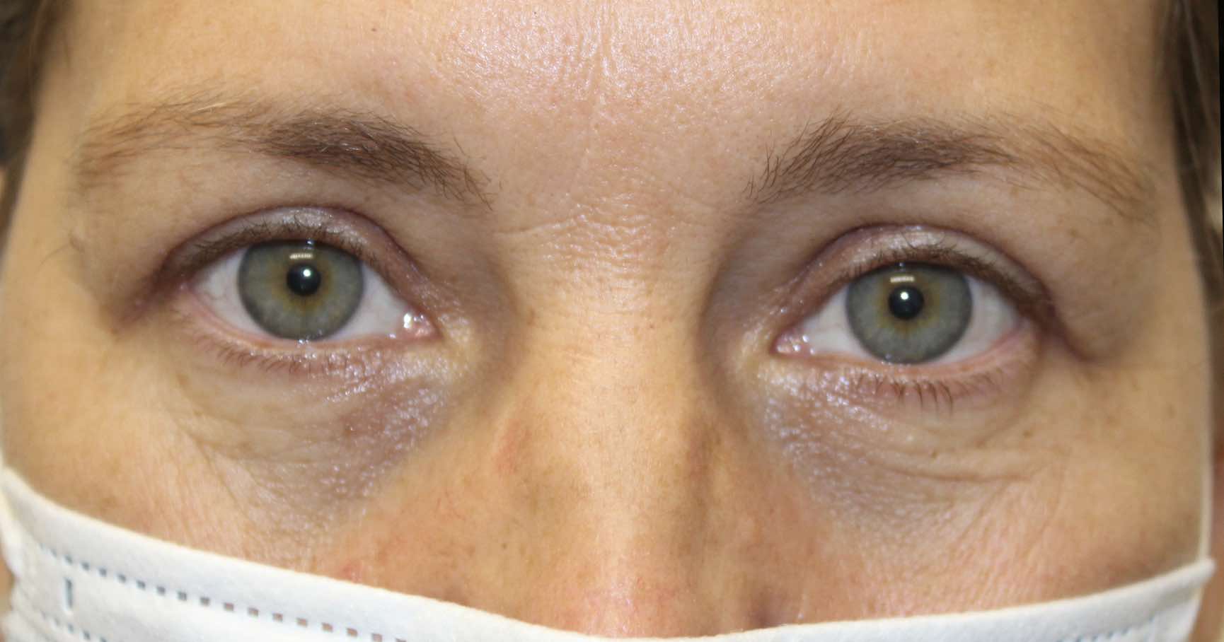 50 year old woman after blepharoplasty upper eye surgery