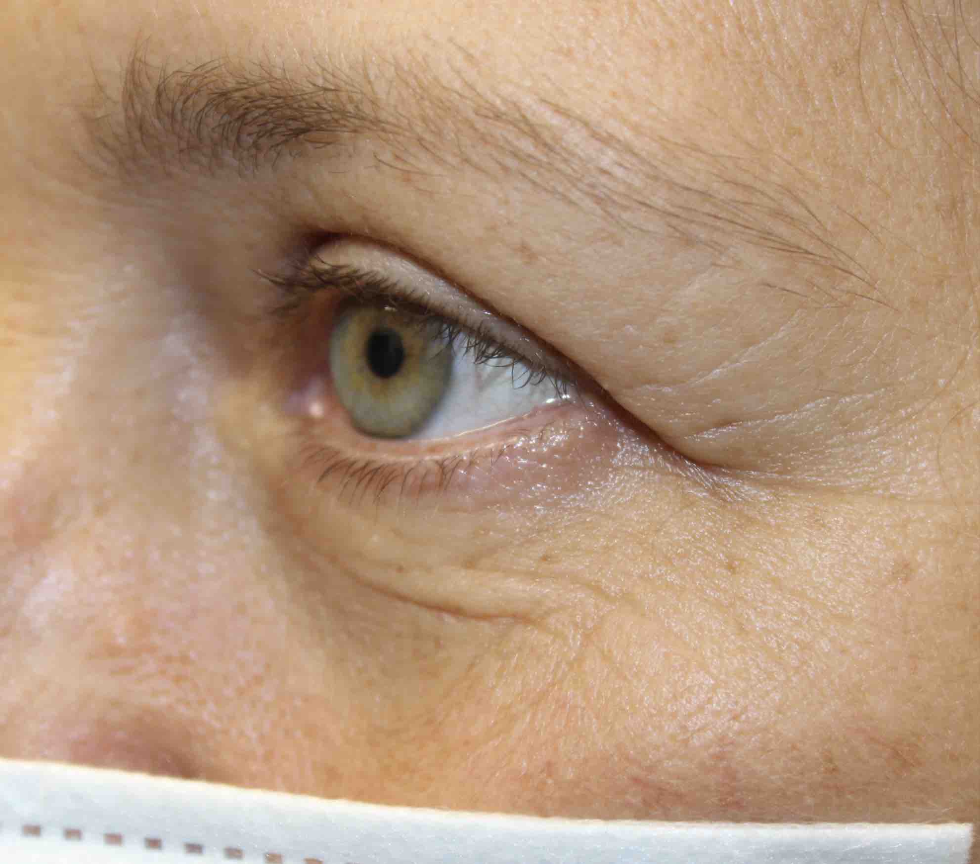 50 year old woman after blepharoplasty procedure