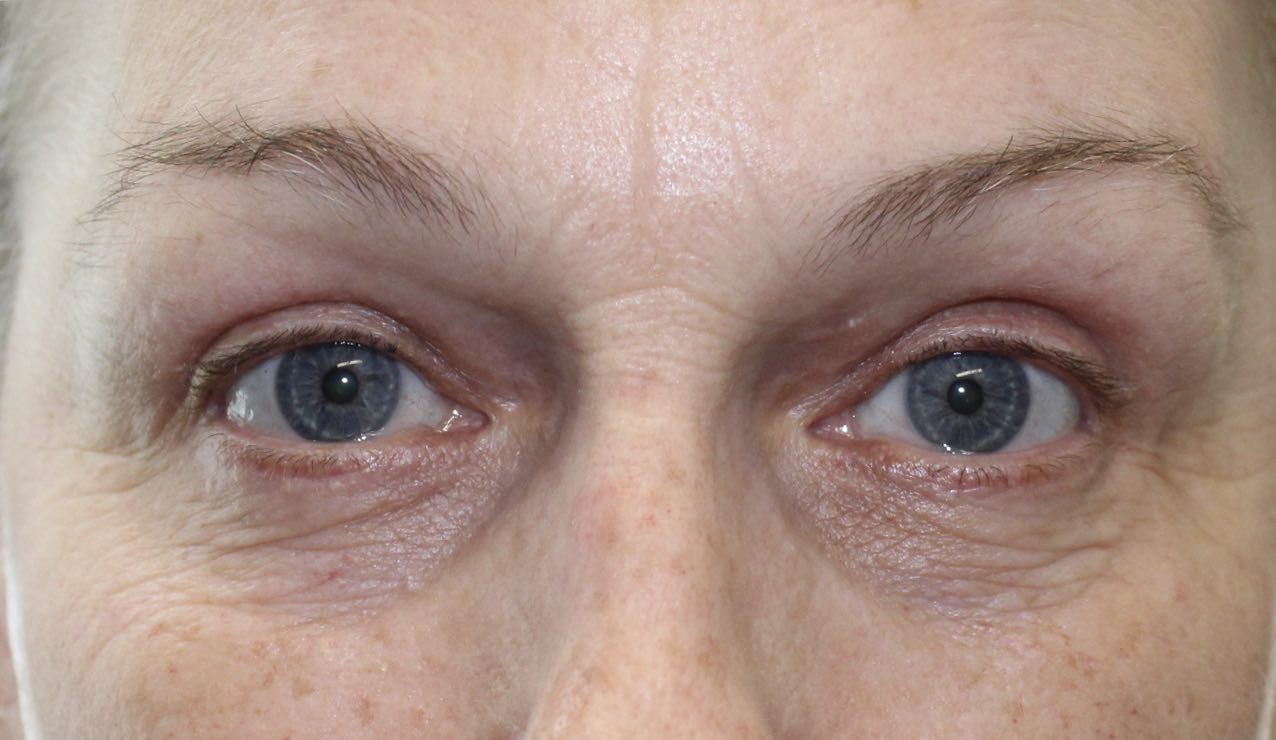 65 year old frontal after upper eyelid blepharoplasty procedure