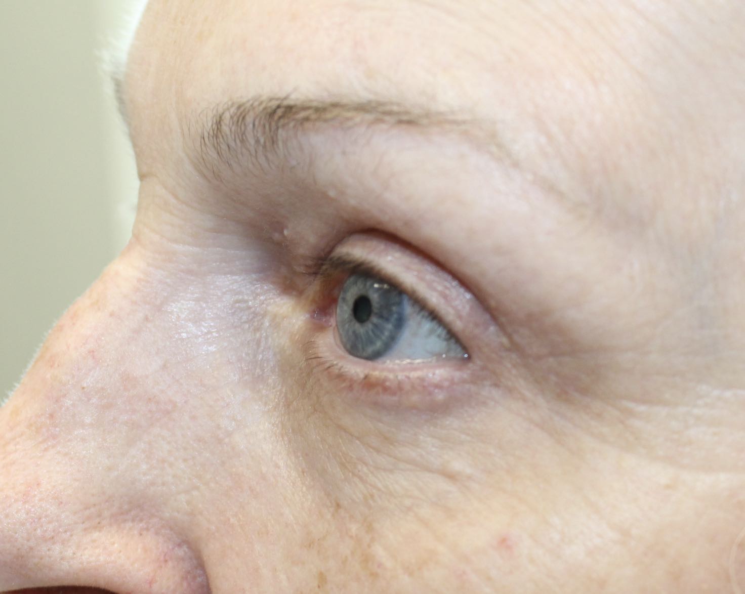 65 year old woman side view after blepharoplasty on the upper eye