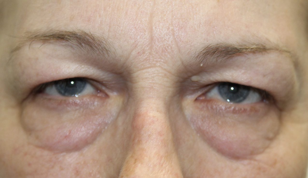 65 year old woman frontal image before upper eye blepharoplasty surgical procedure