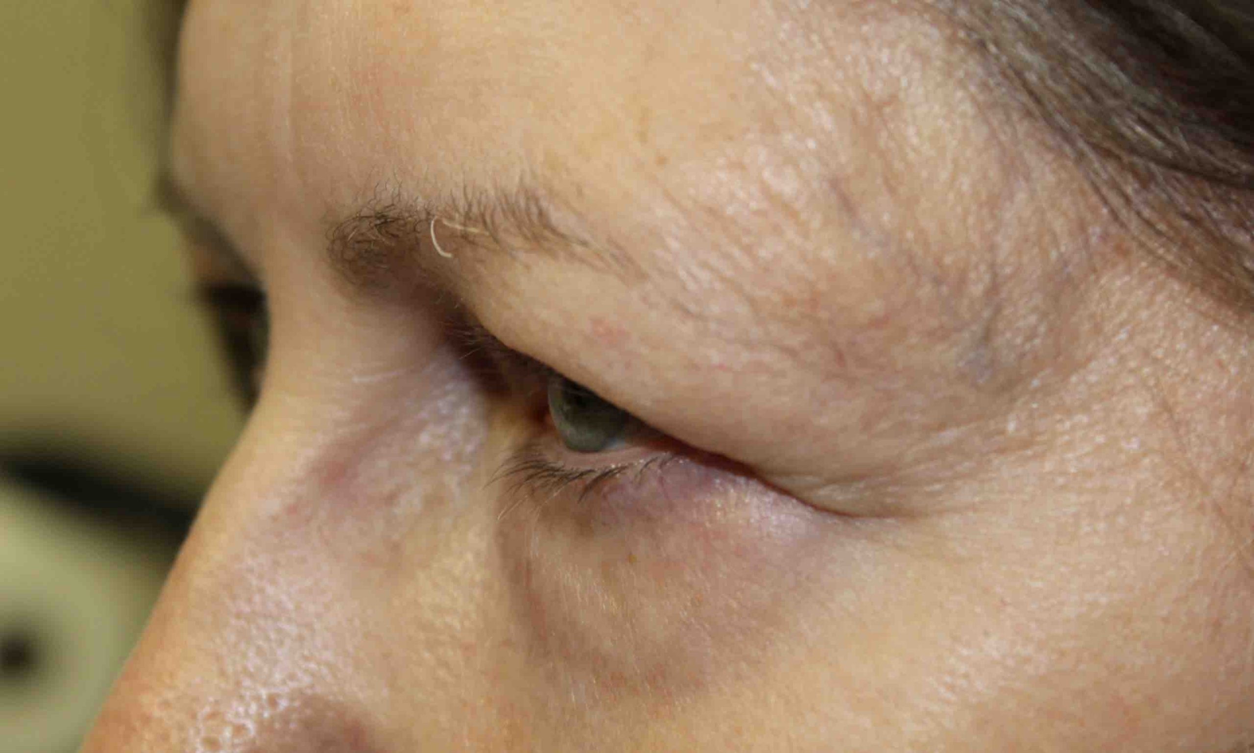 woman before blepharoplasty on the upper eye