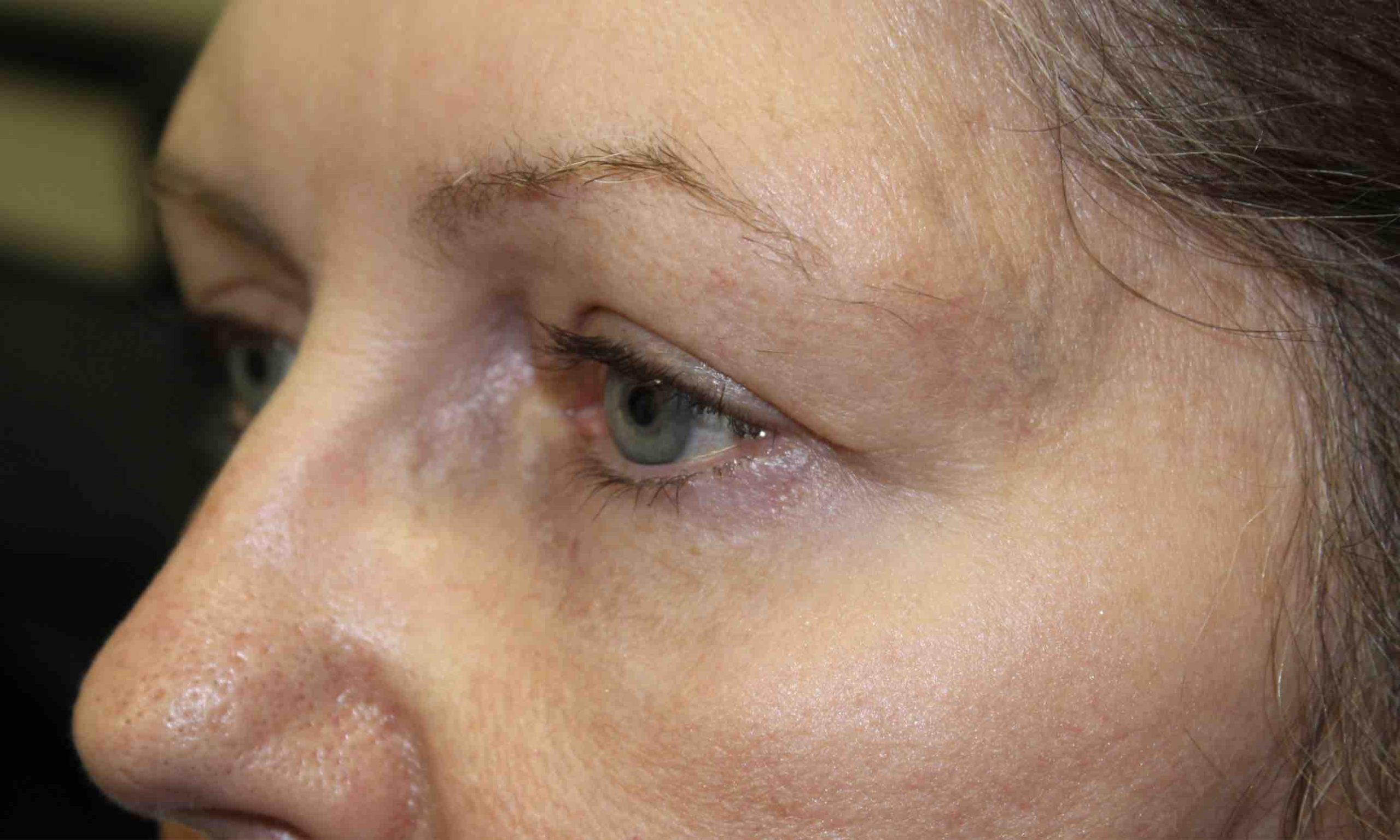 woman after upper blepharoplasty surgery on the eye
