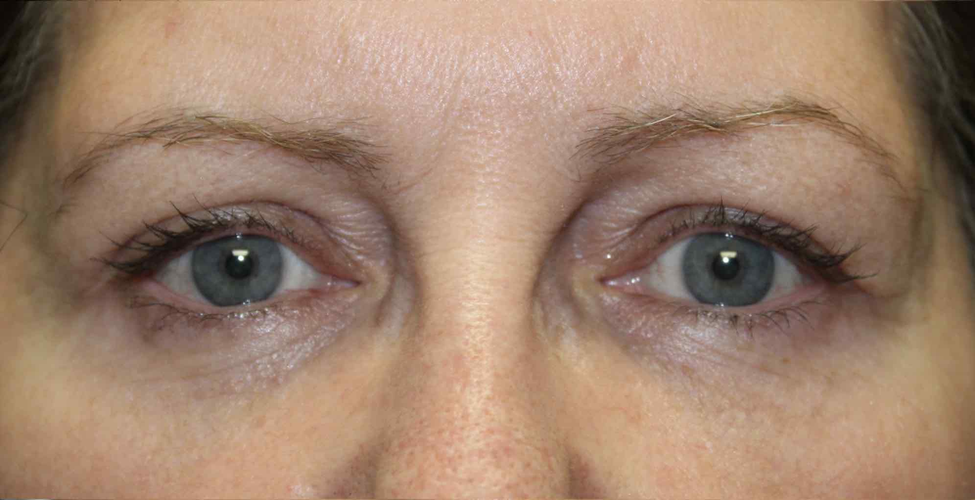 woman after blepharoplasty surgery on the eye