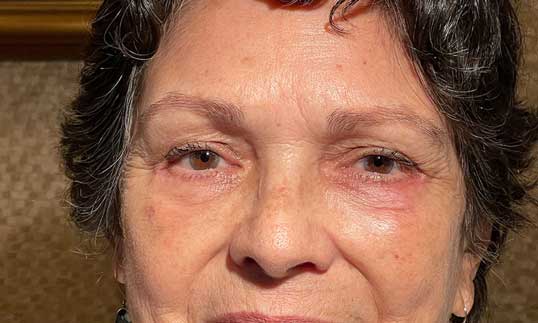 female after lower blepharoplasty eye surgery