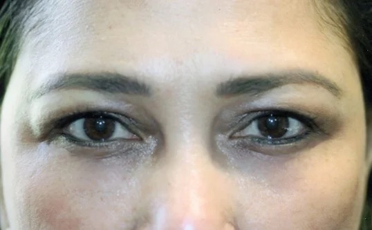 womans upper face after undergoing botox treatment