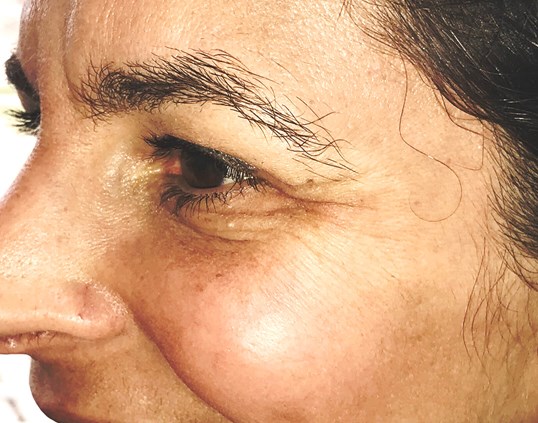 womans wrinkles around eye