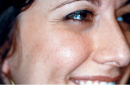 laser skin resurfacing results on female patient on middle face