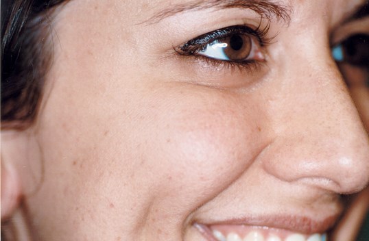 laser skin resurfacing results on female patient smiling