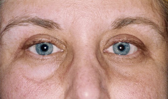 laser skin resurfacing results around a patients middle face