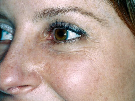 before laser skin resurfacing on patients left eye