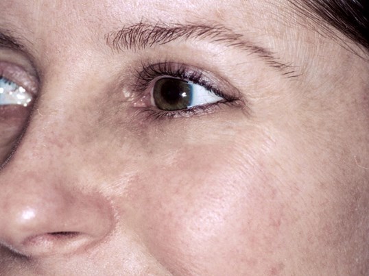 female laser skin resurfacing results around the eyes