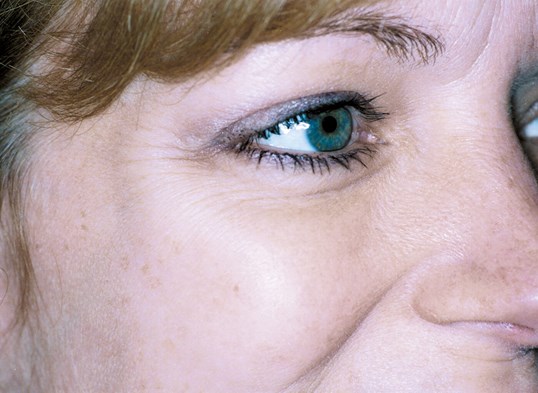 before laser skin resurfacing on female patients right eye