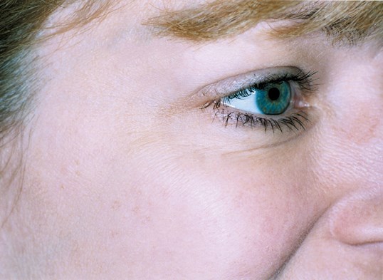 female laser skin resurfacing results around right eye