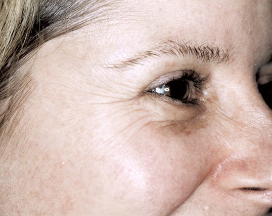 right eye of patient with wrinkles before laser skin resurfacing