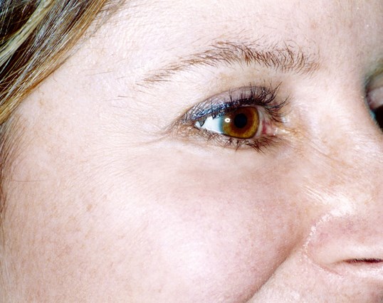 laser sking resurfacing results on womans right eye