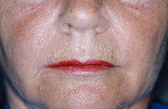 before woman laser skin resurfacing procedure around the lips