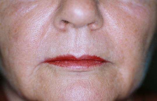 womans laser skin resurfacing results on lips