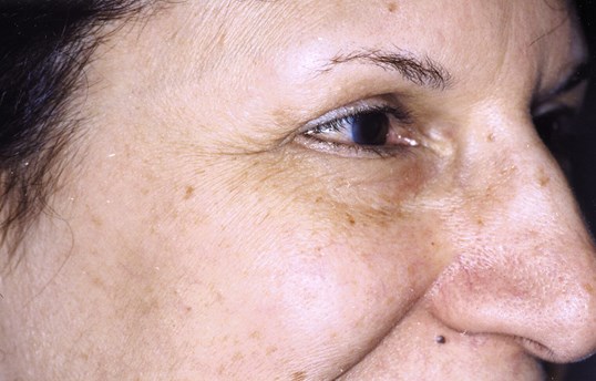 womans wrinkles around the eye before laser skin resurfacing