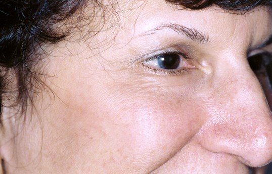 laser skin resurfacing procedure results on woman