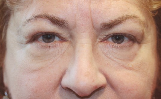 close up womans eyes older patient before drop n' lift surgery