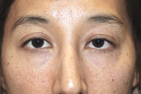 female patients eyes before drop n' lift procedure