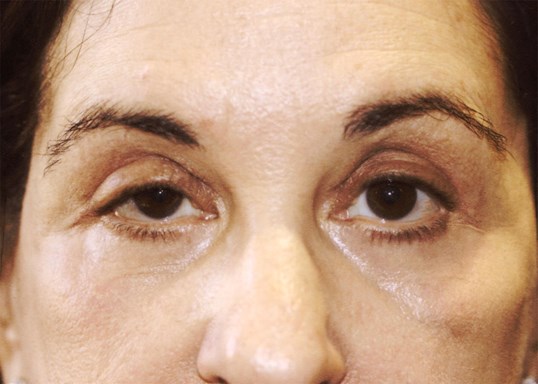 female patients eyes before drop n' lift surgery