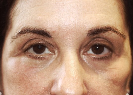 after drop n lift procedure by sightmd