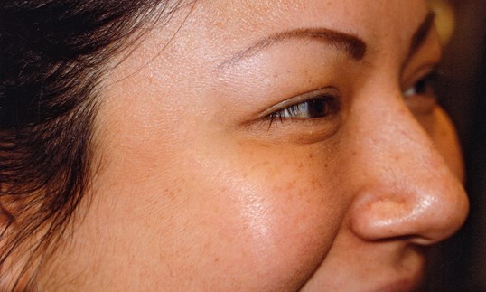 botox injections results on female patient