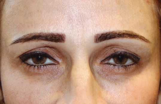 patient before drop n' lift surgical procedure at sightmd