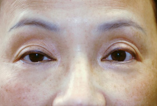 female patient before sight md drop n' lift surgery
